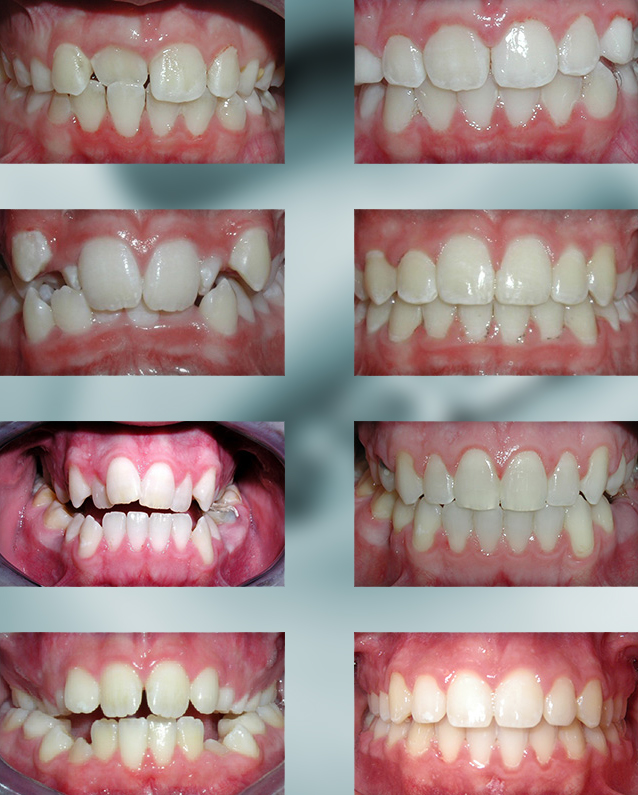 cross-bite Teeth