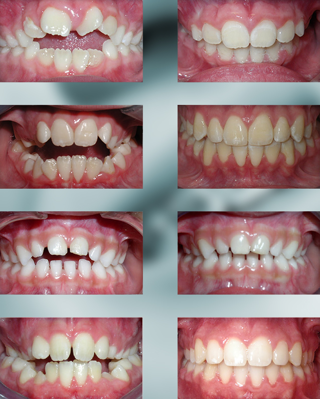 Open Bite Teeth